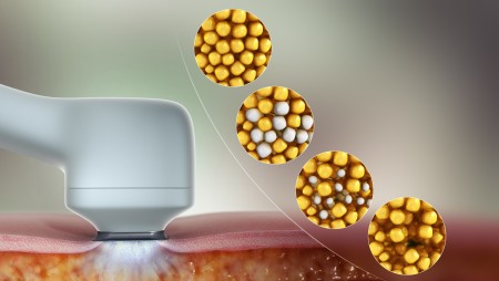 cryolipolyse fonctionnement