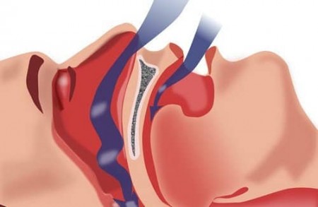 Cause de l'apnée de sommeil